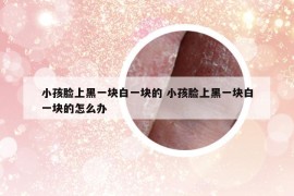 小孩脸上黑一块白一块的 小孩脸上黑一块白一块的怎么办