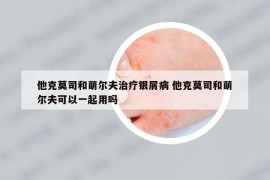 他克莫司和萌尔夫治疗银屑病 他克莫司和萌尔夫可以一起用吗