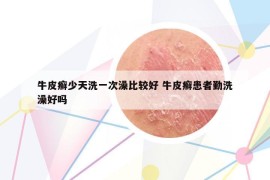 牛皮癣少天洗一次澡比较好 牛皮癣患者勤洗澡好吗