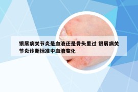 银屑病关节炎是血液还是骨头里过 银屑病关节炎诊断标准中血液变化
