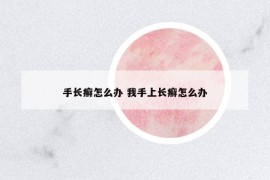 手长癣怎么办 我手上长癣怎么办
