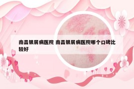 南昌银屑病医院 南昌银屑病医院哪个口碑比较好