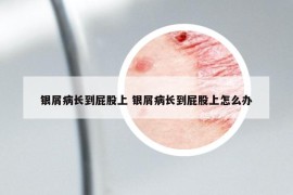 银屑病长到屁股上 银屑病长到屁股上怎么办