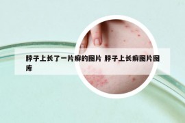 脖子上长了一片癣的图片 脖子上长癣图片图库