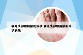 婴儿头部银屑病的症状 婴儿头部银屑病的症状表现