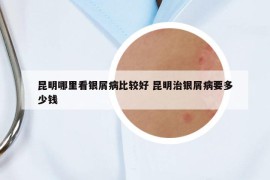 昆明哪里看银屑病比较好 昆明治银屑病要多少钱