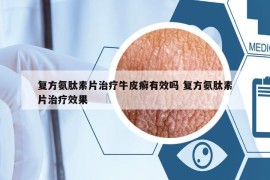 复方氨肽素片治疗牛皮癣有效吗 复方氨肽素片治疗效果