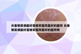 长春银屑病最好是哪家医院最好的医院 长春银屑病最好是哪家医院最好的医院呢