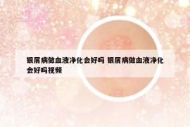 银屑病做血液净化会好吗 银屑病做血液净化会好吗视频