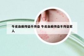 牛皮血癣传染不传染 牛皮血癣传染不传染家人