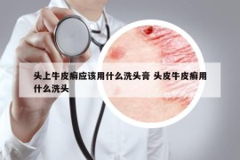 头上牛皮癣应该用什么洗头膏 头皮牛皮癣用什么洗头