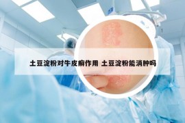 土豆淀粉对牛皮癣作用 土豆淀粉能消肿吗
