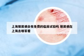 上海银屑病会有免费的临床试验吗 银屑病在上海去哪家看