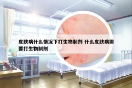 皮肤病什么情况下打生物制剂 什么皮肤病需要打生物制剂
