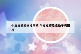 牛皮皮癣能吃柚子吗 牛皮皮癣能吃柚子吗图片