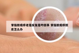 掌指脓疱疹老是反复是咋回事 掌指脓疱疹脱皮怎么办