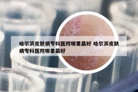 哈尔滨皮肤病专科医院哪里最好 哈尔滨皮肤病专科医院哪里最好