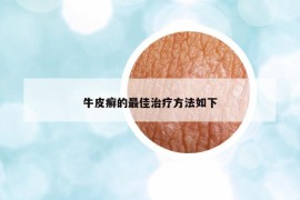牛皮癣的最佳治疗方法如下