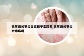 银屑病关节炎生完孩子走路累 银屑病关节炎会瘫痪吗