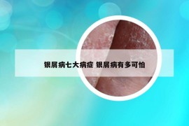 银屑病七大病症 银屑病有多可怕