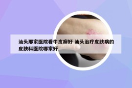 汕头那家医院看牛皮癣好 汕头治疗皮肤病的皮肤科医院哪家好