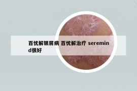百忧解银屑病 百忧解治疗 seremind很好