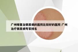 广州哪里治银屑病的医院比较好的医院 广州治疗银屑病专家排名
