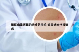 银屑病是医保的治疗范围吗 银屑病治疗报销吗