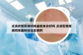 点滴状银屑病切除扁桃体会好吗 点滴型银屑病切除扁桃体治愈病例