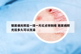 银屑病光照后一挠一片红点特别痒 银屑病照光后多久可以洗澡