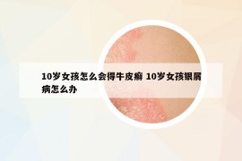 10岁女孩怎么会得牛皮癣 10岁女孩银屑病怎么办