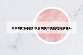 银屑病红标阿胶 银屑病关节炎能吃阿胶糕吗