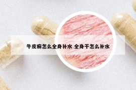 牛皮癣怎么全身补水 全身干怎么补水