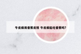 牛皮癣用香蕉皮擦 牛皮癣能吃香蕉吗?