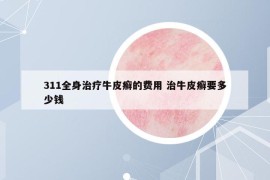 311全身治疗牛皮癣的费用 治牛皮癣要多少钱