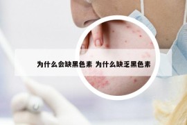 为什么会缺黑色素 为什么缺乏黑色素