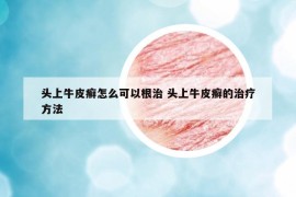 头上牛皮癣怎么可以根治 头上牛皮癣的治疗方法