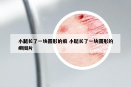 小腿长了一块圆形的癣 小腿长了一块圆形的癣图片
