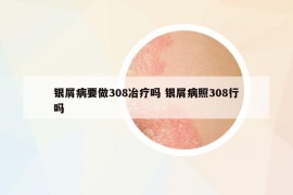 银屑病要做308冶疗吗 银屑病照308行吗