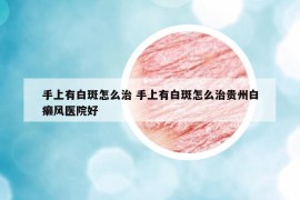 手上有白斑怎么治 手上有白斑怎么治贵州白癞风医院好
