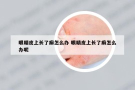眼睛皮上长了癣怎么办 眼睛皮上长了癣怎么办呢