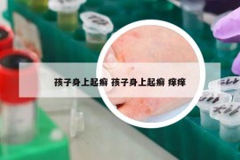 孩子身上起癣 孩子身上起癣 痒痒