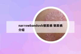 narrowbanduvb银屑病 银屑病介绍