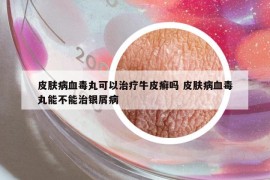 皮肤病血毒丸可以治疗牛皮癣吗 皮肤病血毒丸能不能治银屑病
