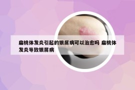 扁桃体发炎引起的银屑病可以治愈吗 扁桃体发炎导致银屑病