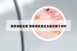 银屑病最宜居 银屑病患者适合居住哪个城市