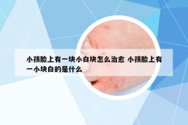 小孩脸上有一块小白块怎么治愈 小孩脸上有一小块白的是什么