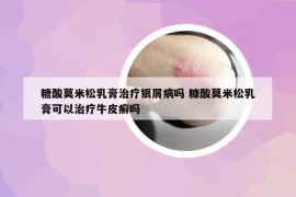 糖酸莫米松乳膏治疗银屑病吗 糠酸莫米松乳膏可以治疗牛皮癣吗
