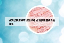 点滴状银屑病可以治好吗 点滴状银屑病自愈征兆