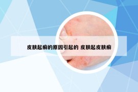 皮肤起癣的原因引起的 皮肤起皮肤癣